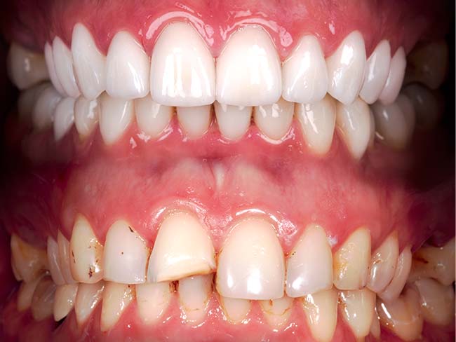 elgin-dental-veneers-belive-it-before-and-after Elgin Dental Veneers believe it before and after