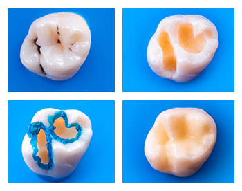 elgin dentist composite fillings