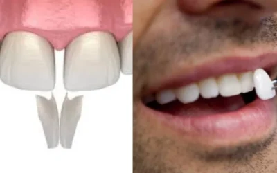 Cost Dental Bonding vs Veneers: Understanding Your Best Smile Investment