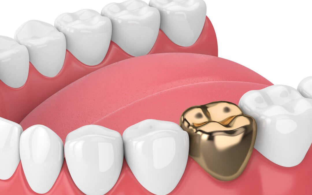 dental crown cost near me
