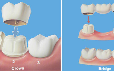 Dental Crowns and Bridges: Costs, Benefits & Comparison Guide