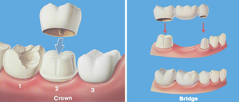 dental crowns and bridges