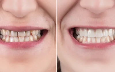 Dental Veneers Before and After: Real Patient Transformations