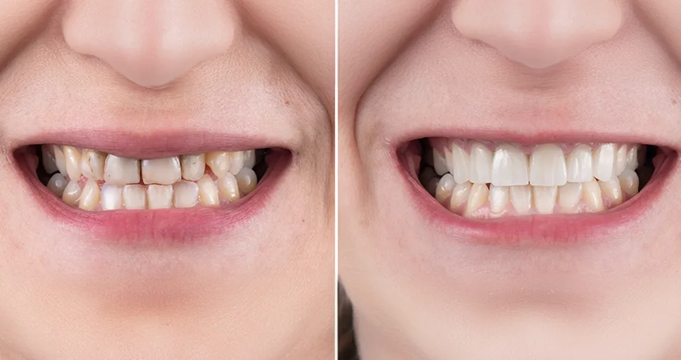 Dental Veneers Before and After: Real Patient Transformations