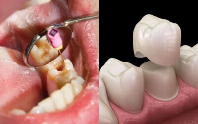 Root Canal and Crown: Procedure, Cost & Recovery Guide