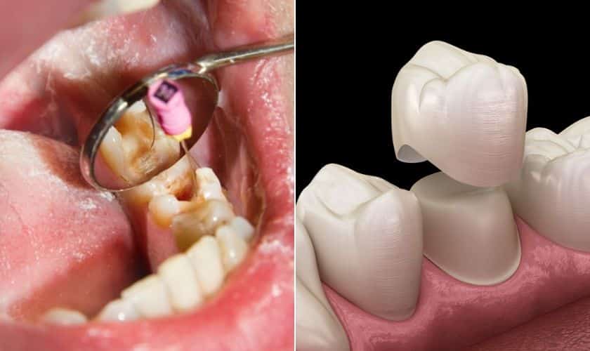 root canal and crown