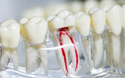 Your Complete Guide to a Root Canal Before and Afte