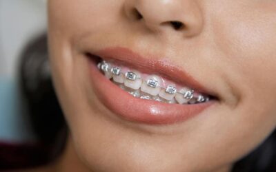 Traditional Metal Braces: Effective & Affordable Smile Care