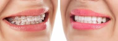 teeth after braces featured image