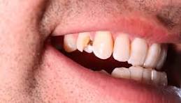 Broken Tooth Repair | Fast, Professional Solutions