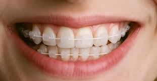 ceramic braces cost featured image