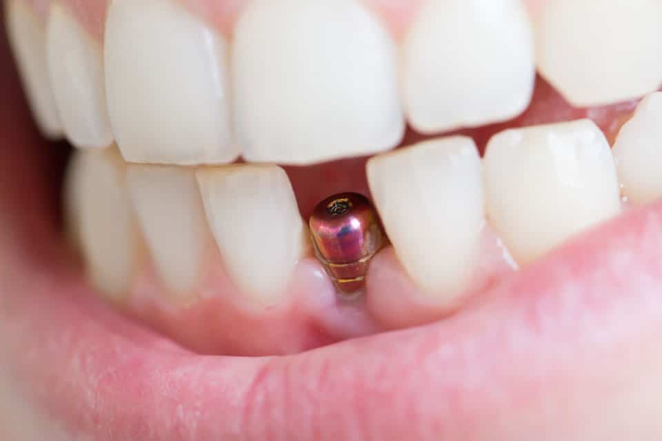 dental implants near me featured image
