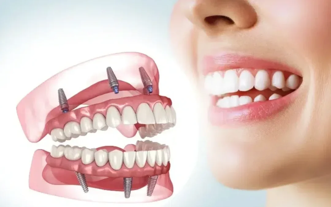 full mouth dental implants featured image